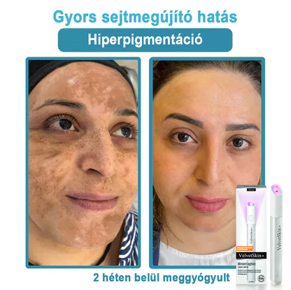 ✨ Bikenda®  – Laserowy Długopis CO₂ do Usuwania 🟤 Znamion, 🦠 Brodawek, 🔘 Przebarwień i Innych Niedoskonałości Skóry）🧿