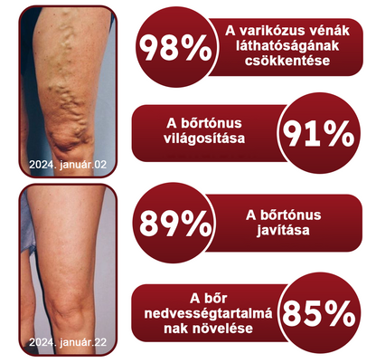 🏥 Furzero™ Pióca visszérkrém (az SSDV Skin Institute által ajánlott)