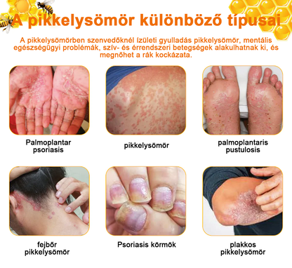 👩‍⚕️🐝Zoencgz™ méhméreg pikkelysömör eltávolító krém🏥 (Az SSDV Skin Institute ajánlása)