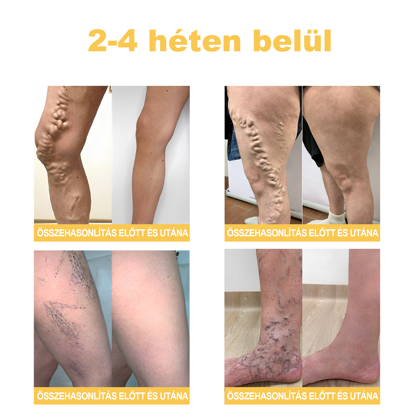 🏆🌈Zoencgz™ méhméreg ízületi gyulladás és visszér kezelő krém✨