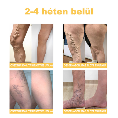 🏆🌈Zoencgz™ méhméreg ízületi gyulladás és visszér kezelő krém✨