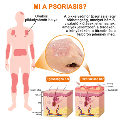 👨‍⚕Furzero™ Psoriasis Treatment Spray-t a viszketés és a gyulladás csökkentése érdekében 2 hét után. (Dr. Károlyi Krisztina: hiteles ajánlás)