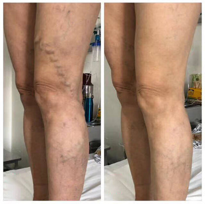 🏥 Furzero™ Pióca visszérkrém (az SSDV Skin Institute által ajánlott)