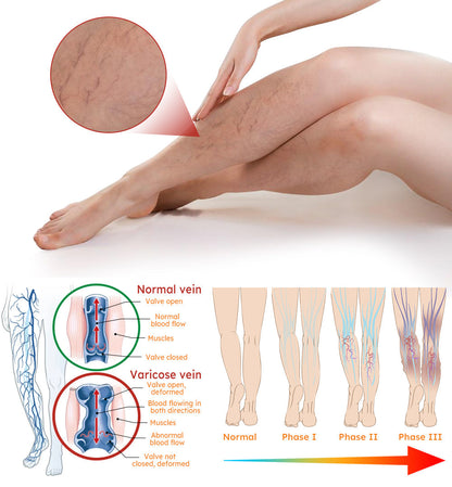 👩‍⚕️Furzero™ kurkuma visszér tapasz(Az SSDV Skin Institute ajánlása)