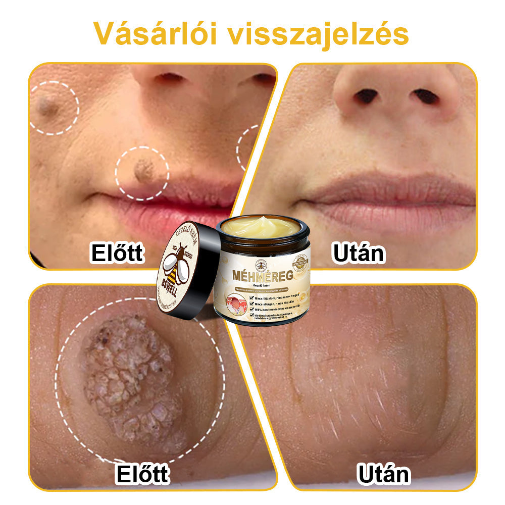 🐝✨𝑩𝑺𝑾𝑬𝑳𝑳® 𝑴é𝒉𝒎é𝒓𝒆𝒈 𝑲𝒆𝒛𝒆𝒍é𝒔 𝑲𝒓é𝒎👨‍⚕️（𝑫𝒆𝒓𝒎𝒂𝒕𝒐𝒍ó𝒈𝒖𝒔 𝒂𝒋á𝒏𝒍á𝒔𝒐𝒌） (🔥𝒖𝒕𝒐𝒍𝒔ó 𝒏𝒂𝒑 𝒑𝒓𝒐𝒎ó𝒄𝒊ó 80% 𝒌𝒊）