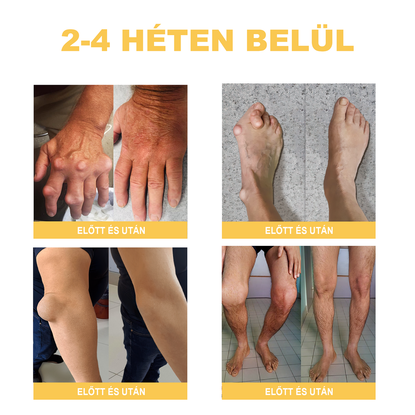 🏆🌈Zoencgz™ méhméreg ízületi gyulladás és visszér kezelő krém✨