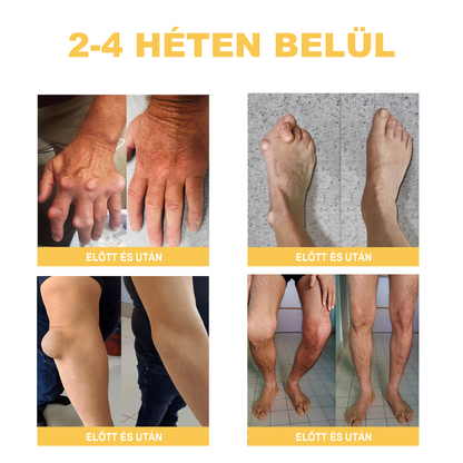 🏆🌈Zoencgz™ méhméreg ízületi gyulladás és visszér kezelő krém✨