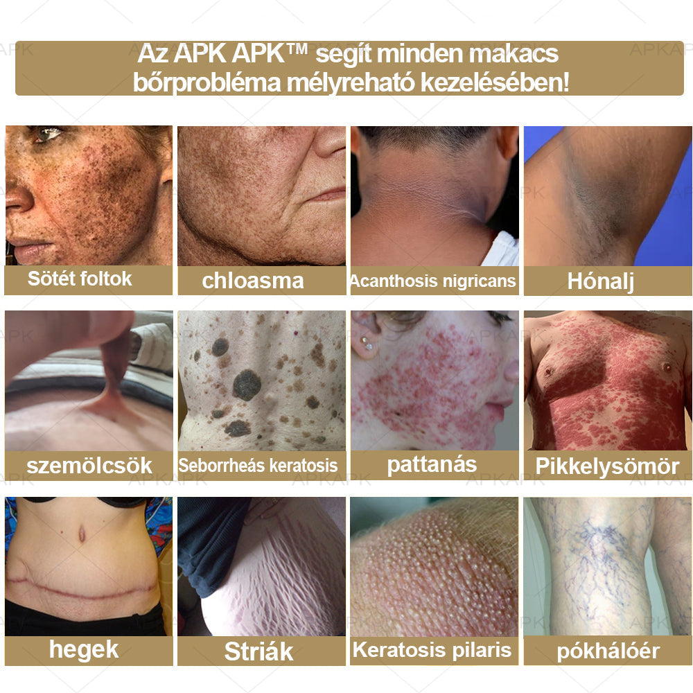 𝐀𝐏𝐊𝐀𝐏𝐊™MéhméregBőrápoló Krém - Jóváhagyva a MagyarDermatológiaiésVenereológiai Társaság (MDDK) és a Nemzeti Népegészségügyi Központ (NNK) által.