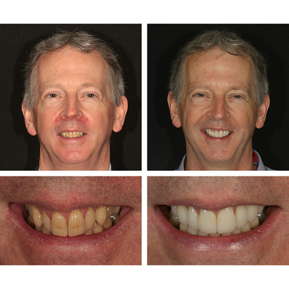 ⏳Limited Time Offer⏳LIMETOW™ Teeth Whitening Essence